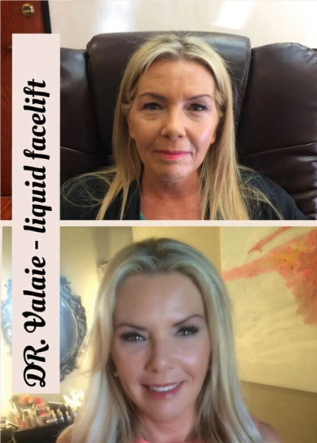 Liquid facelift sample